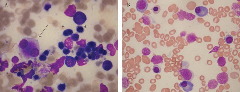 Bone marrow changes in HIV infection – HAEMA